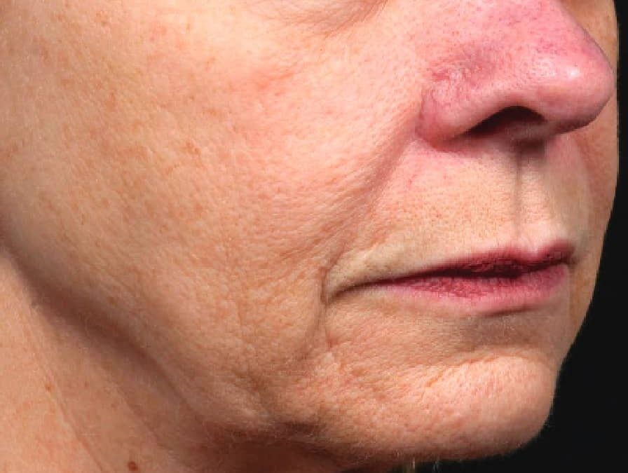 Womans face before treatment with Thermage.