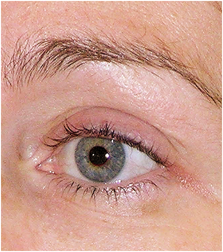 After treatment with Thermage.