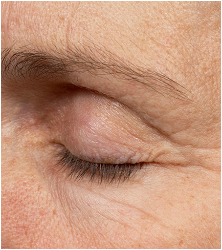 After treatment with Thermage