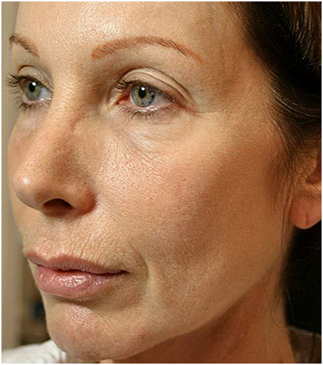 Her face after treatment with Thermage.