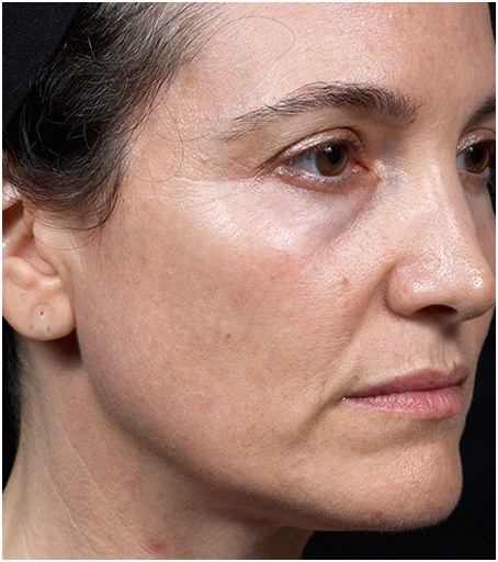 Her face after treatment with Thermage.