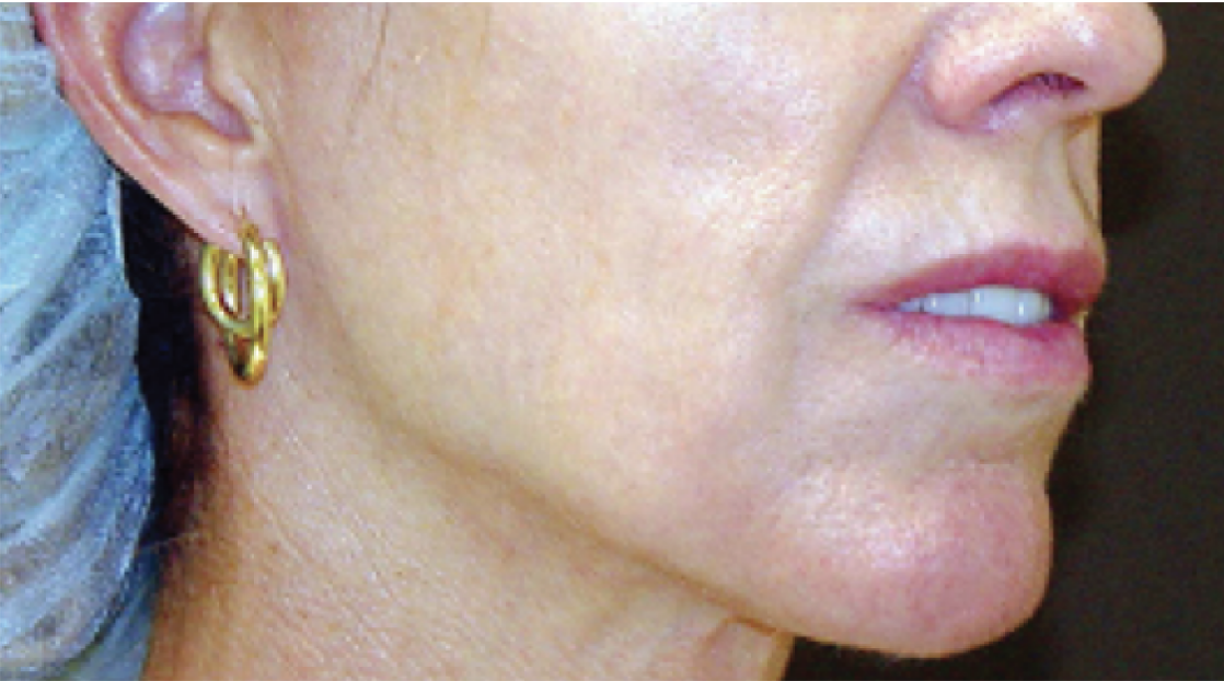 Her face after treatment with Thermage.