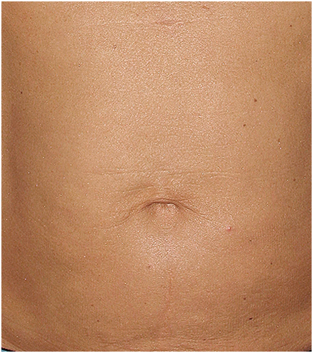 After treatment with Thermage.