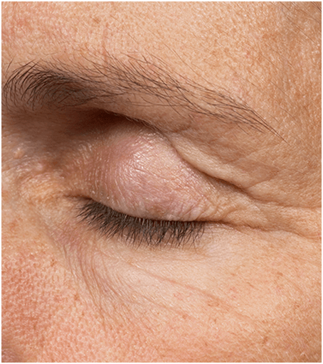 Eyelids before treatment with Thermage