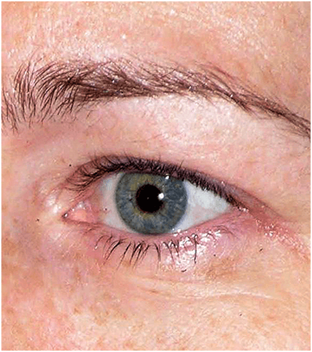 Eyes before treatment with Thermage.