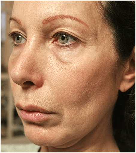 Womans face before treatment with Thermage.