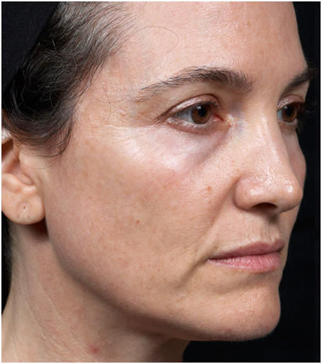 Her face after treatment with Thermage.