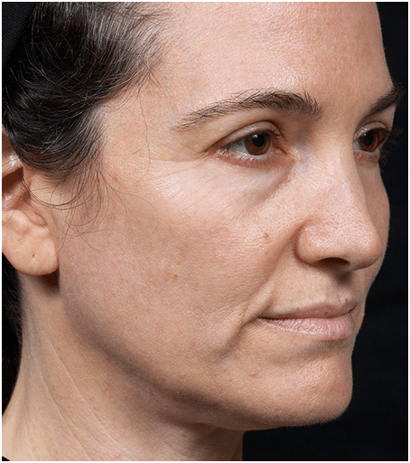 Womans face before
treatment with Thermage.