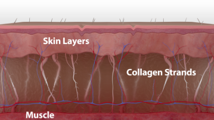 How Thermage works