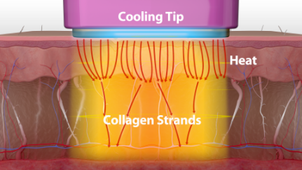 How Thermage works