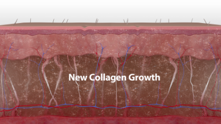 How Thermage works
