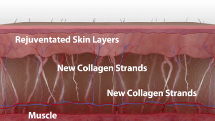 How Thermage works