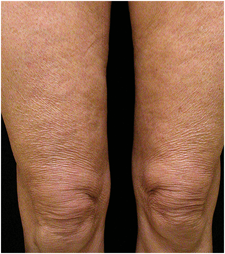 Thighs before treatment with Thermage.