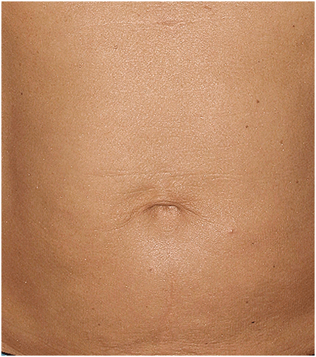 After treatment with Thermage.
