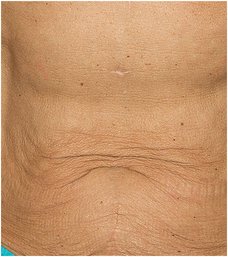 Stomach before treatment with Thermage.