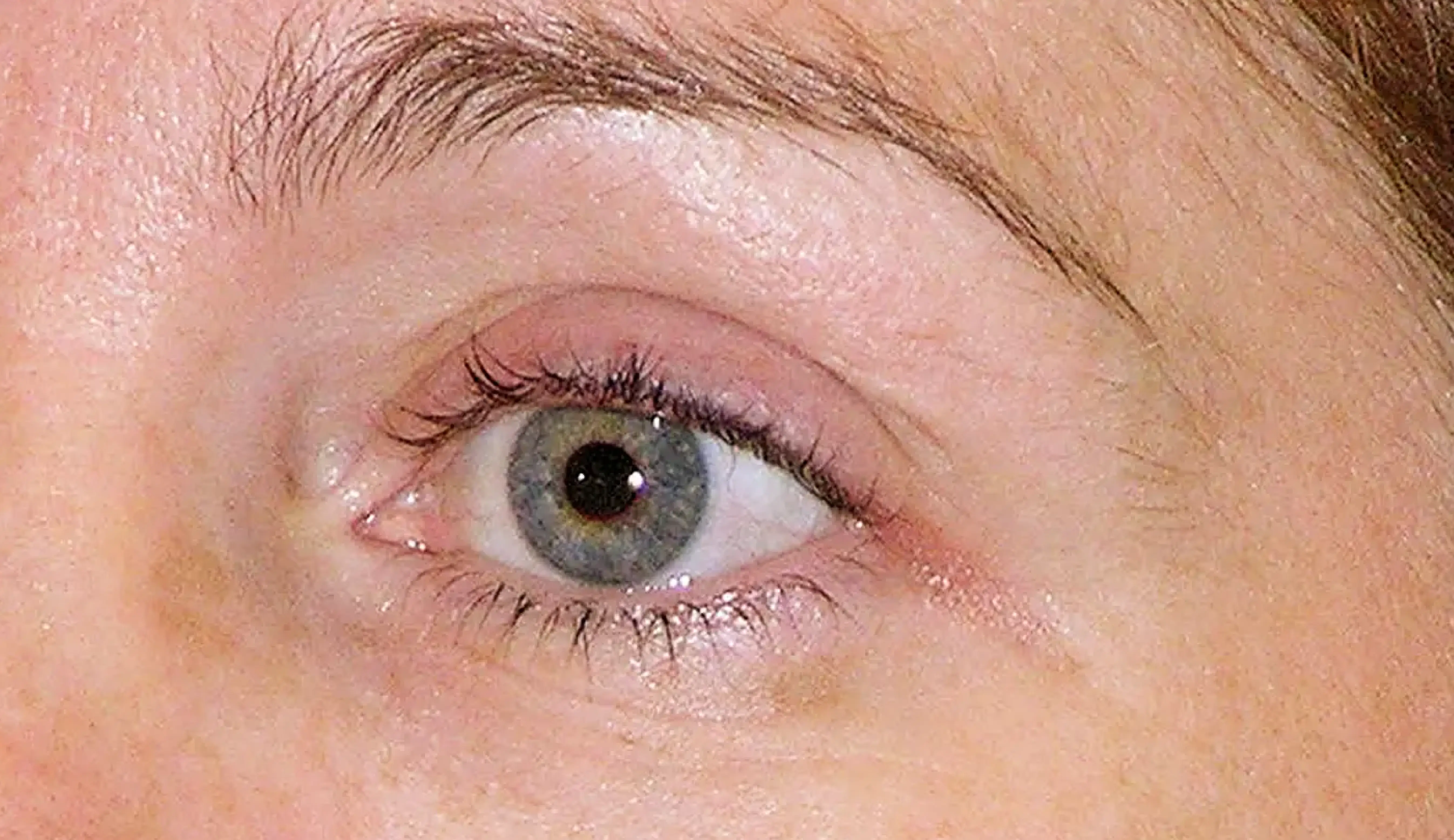 Thermage eye after