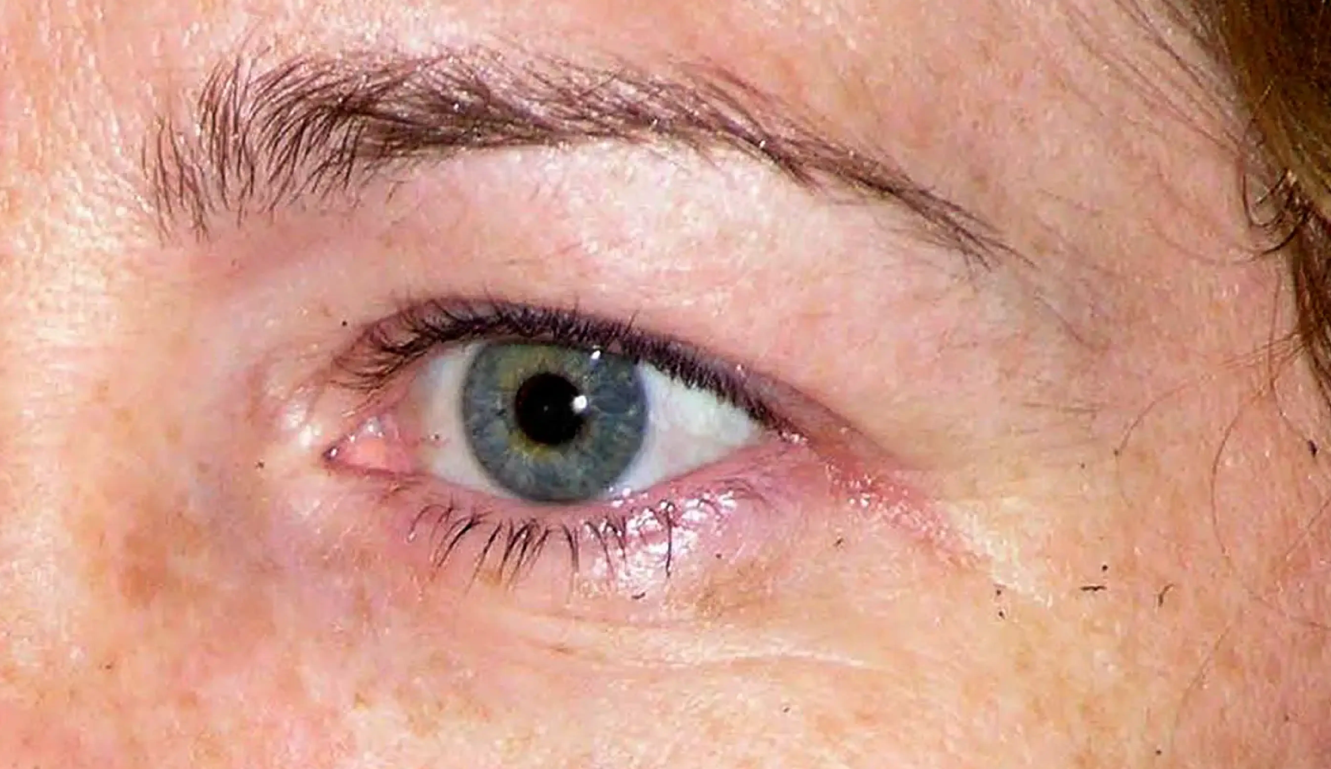 Thermage eye before