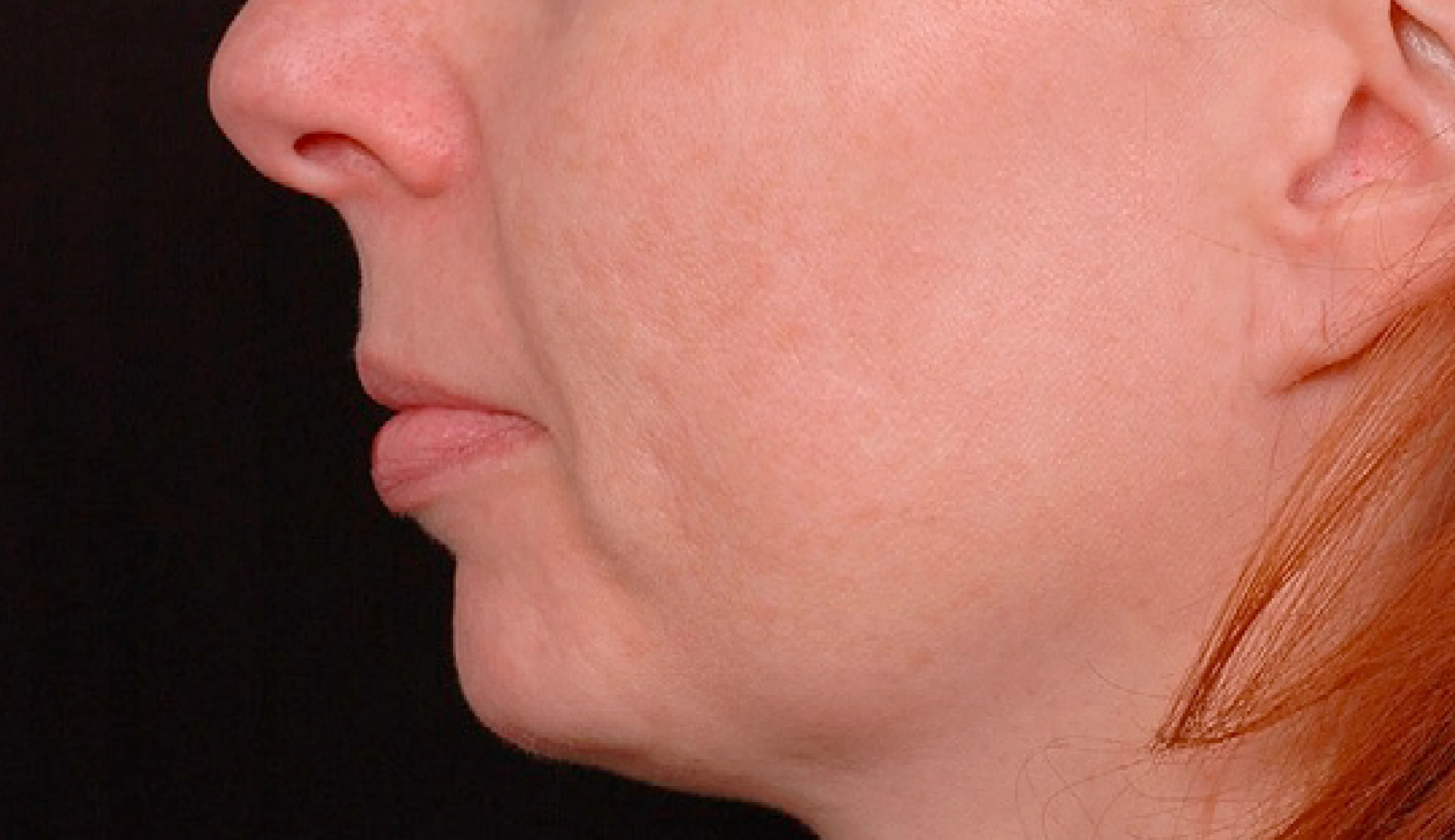 Thermage face after