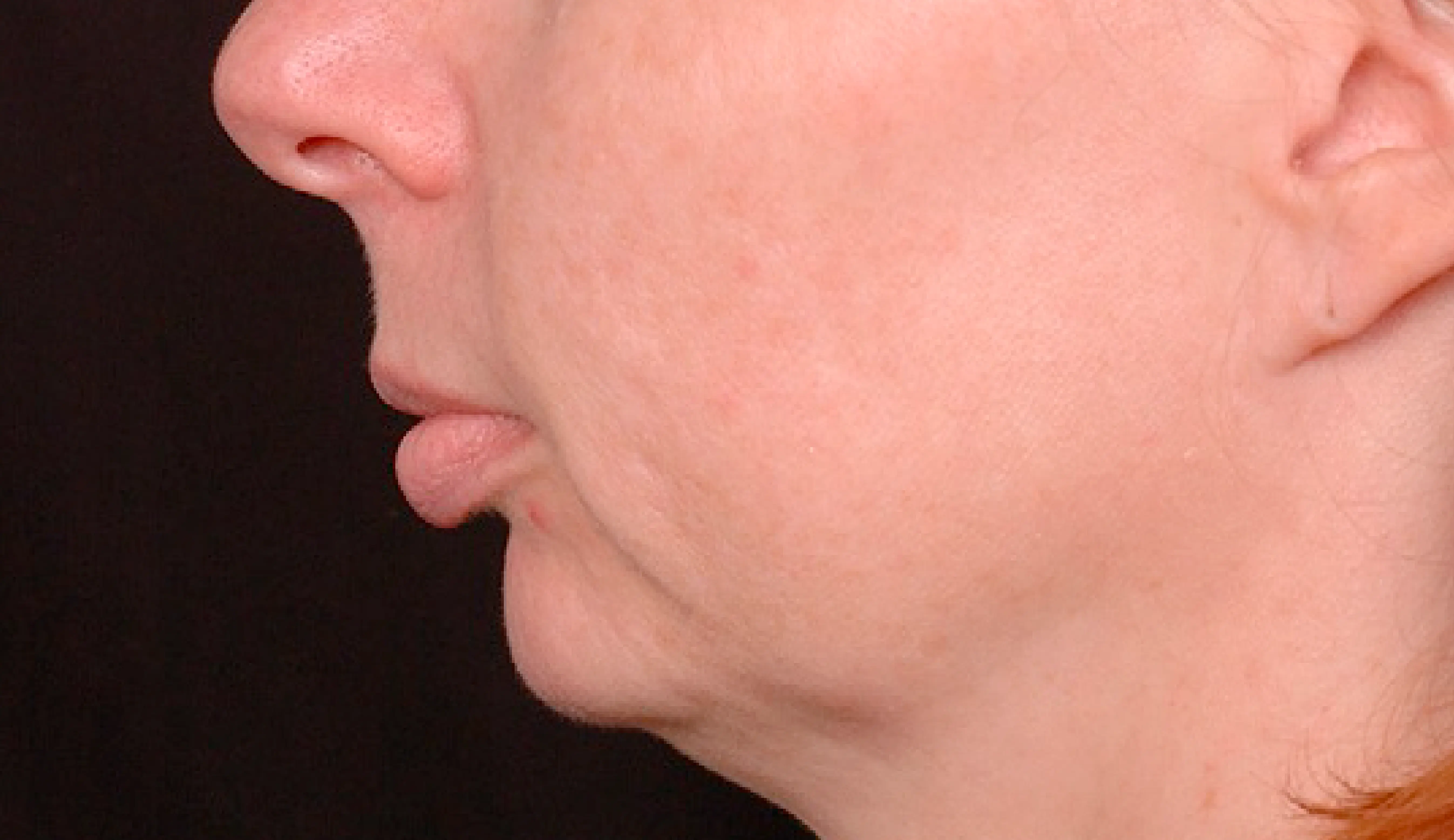 Thermage face before