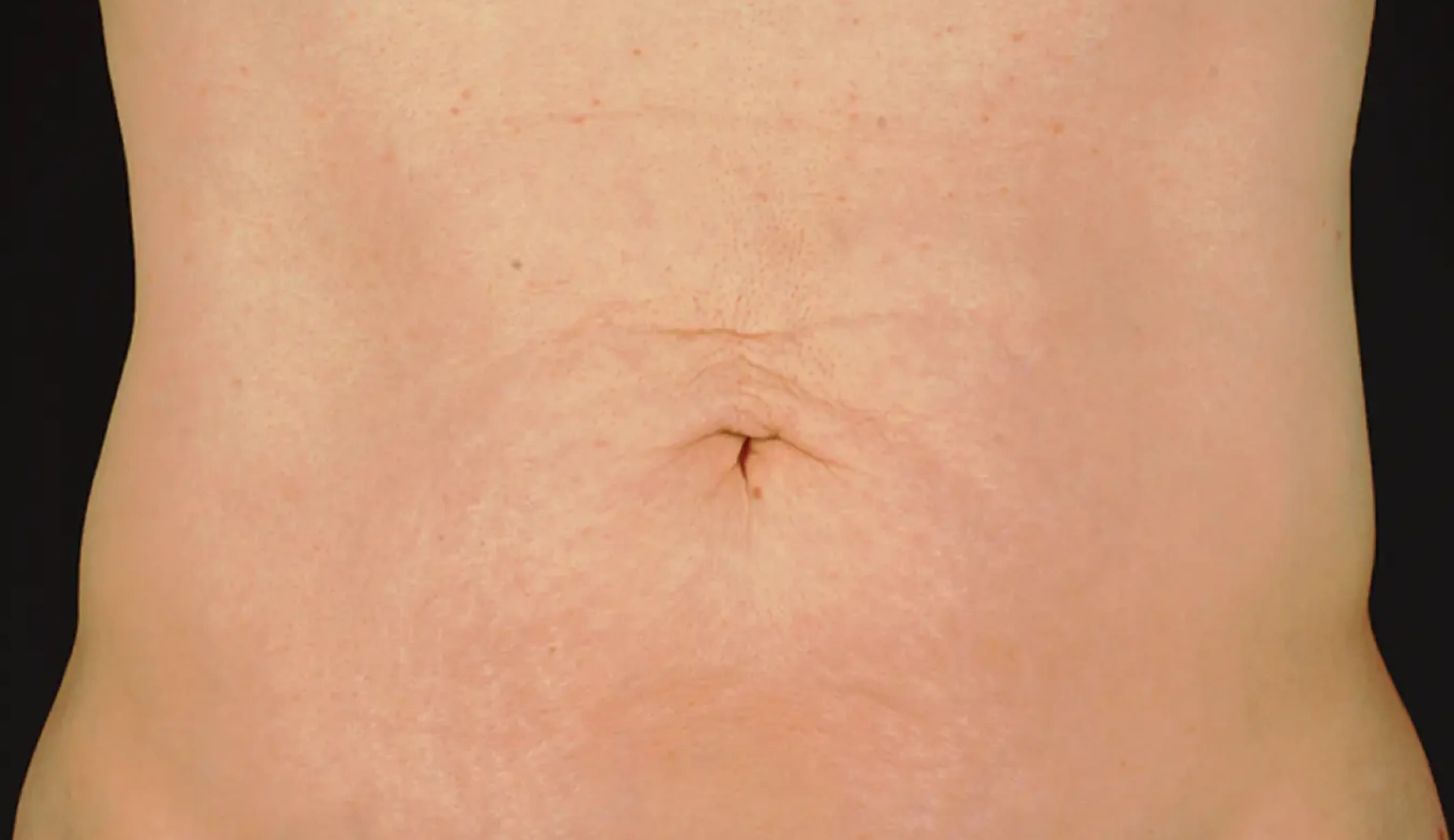 Thermage body after