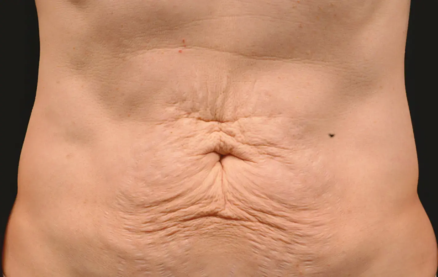 Thermage body before